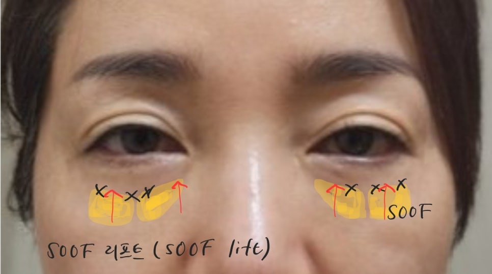 애교살을 보존하는 하안검 수술 관련 이미지 6
