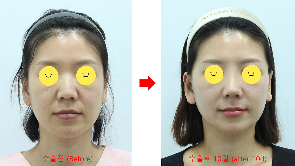 Recovery Period for Midlife Nose Surgery image 3
