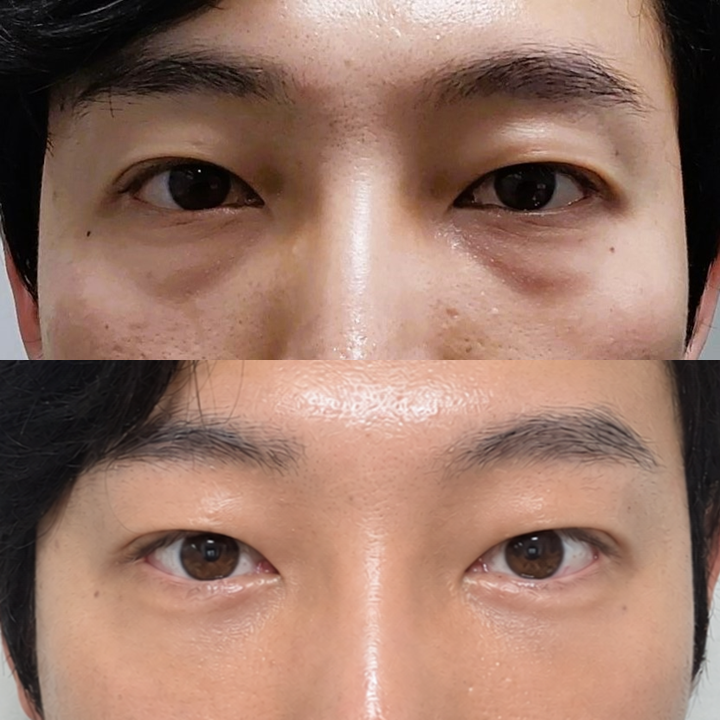 남자도 애교살을 만드나요? 관련 이미지 6