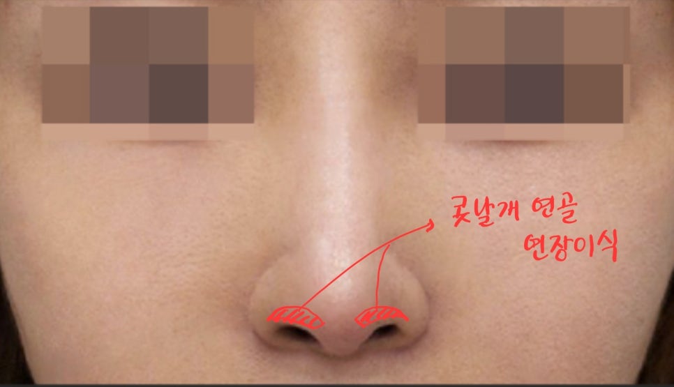 Lengthening Revision Rhinoplasty for a Short, Upturned Nose image 5