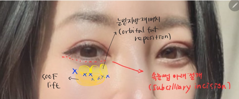 쿼드플러스 하안검 수술의 방법 관련 이미지 3