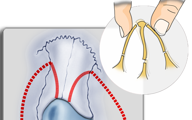 Various Surgical Methods for Crooked Nose Surgery image 3