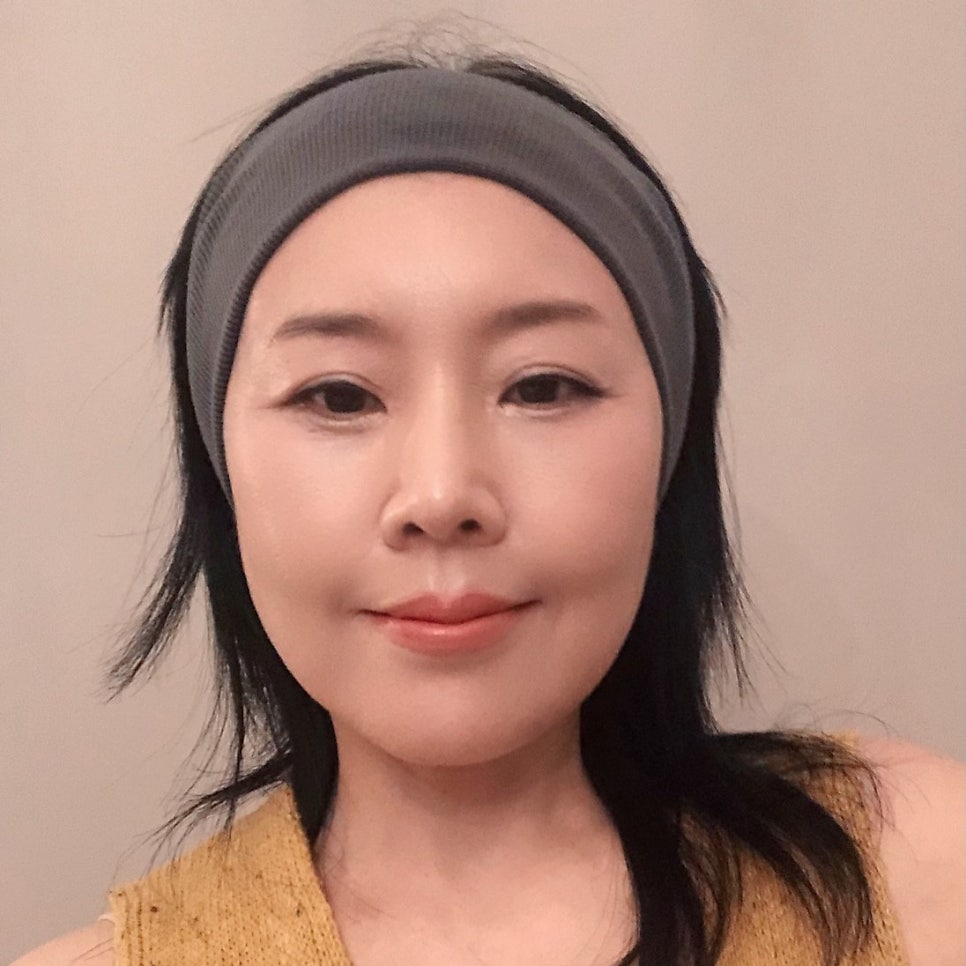 Lower Blepharoplasty in Your 50s to Add Firmness to the Midface image 7