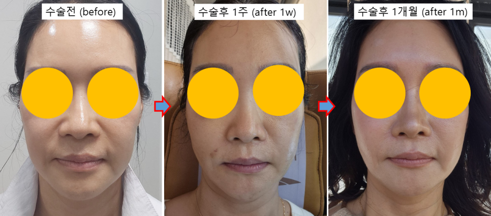 실리프팅, 어떤 실을 어떻게 사용하느냐가 중요한 이유 관련 이미지 5