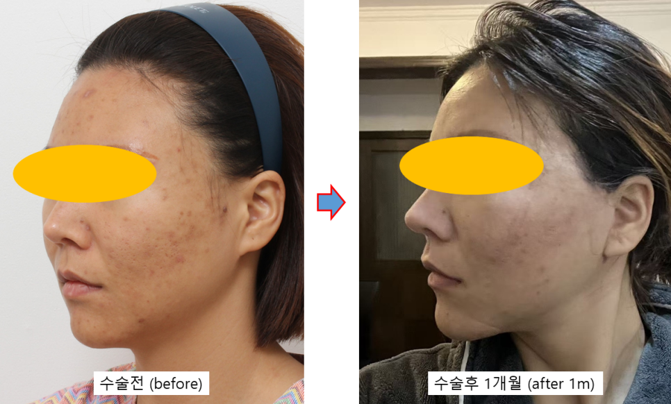미니거상의 진화, MACS에서 딥미니거상(MADE)까지 관련 이미지 5