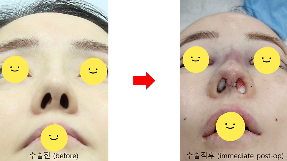 코끝떨어짐 늑연골 재수술 관련 이미지 7