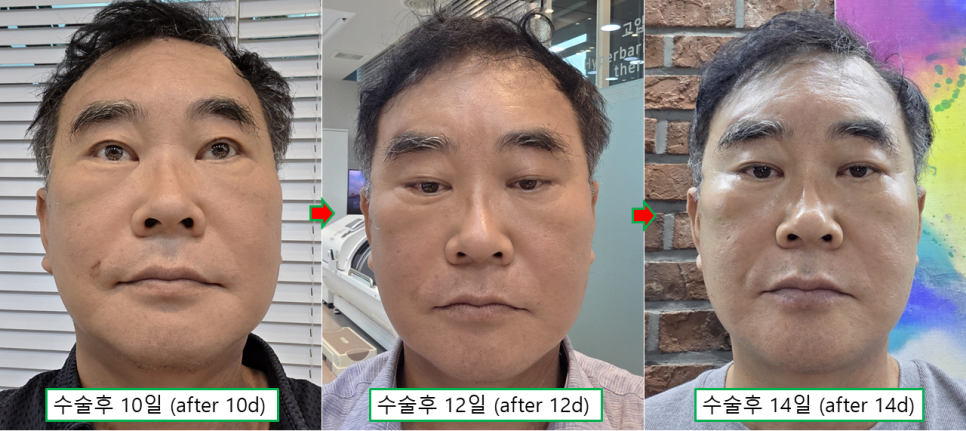 60대 남자 거상수술, 브래드 피트와 비슷한 나이의 실제 수술 사례 관련 이미지 5