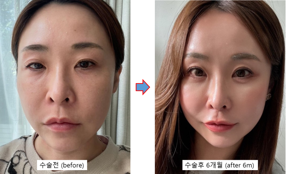 동안과 여성스러움을 동시에, 자연스러운 변화를 만드는 지방이식 관련 이미지 1