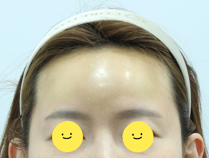 내시경을 이용한 최소절개 이마 보형물 제거 관련 이미지 1
