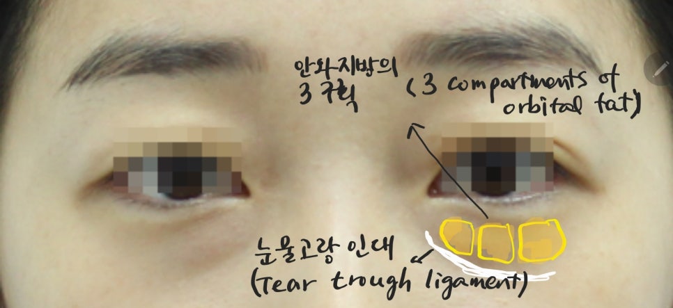 The Surgical Process of Lower Eyelid Fat Repositioning image 2