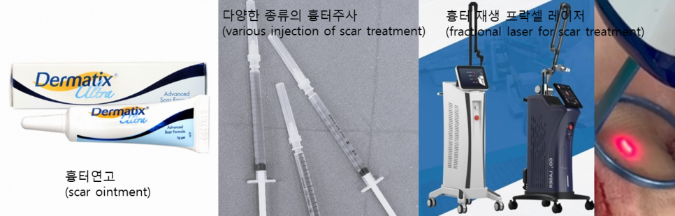 안면거상, 긴 절개선인데 흉터가 눈에 잘 띄지 않는 이유 관련 이미지 7