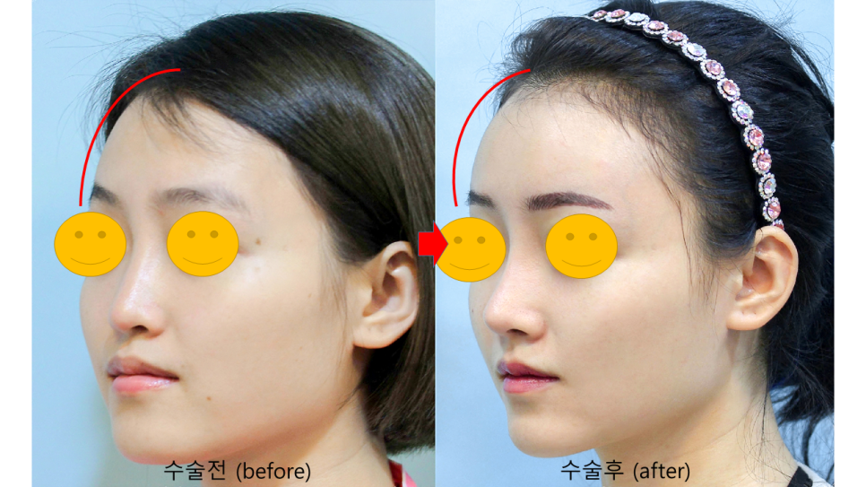 얼굴의 입체감을 살려주는 지방이식 관련 이미지 4