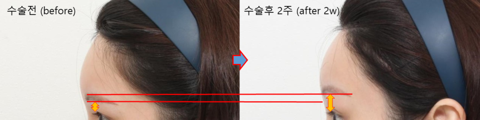 이마 필러를 맞았는데, 이마거상 수술이 가능할까요? 관련 이미지 2