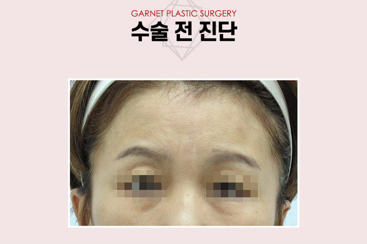 【가넷성형외과 백인수원장 성형칼럼】 펜타픽스이마거상으로 눈썹 비대칭 교정 관련 이미지 3