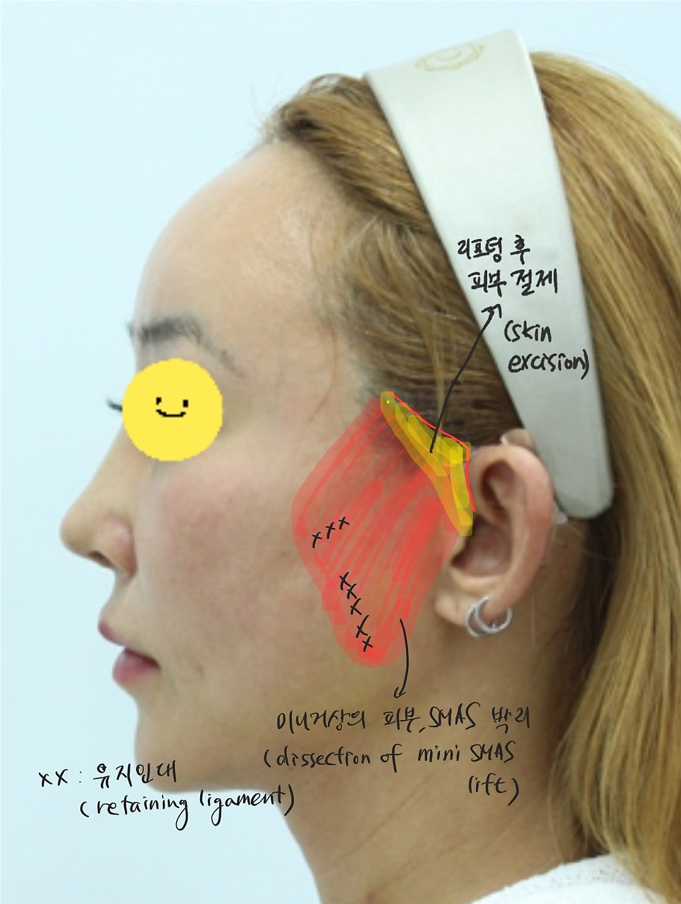 히든(hidden) 미니거상의 수술방법과 회복기간 관련 이미지 2