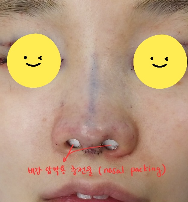 Treatment Process to Speed Recovery After Rhinoplasty image 1
