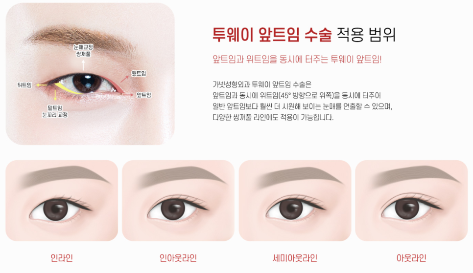앞트임 재수술에서 윗트임의 중요성 관련 이미지 4