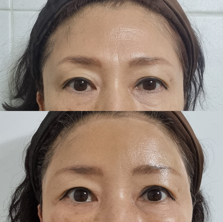 안티에이징 수술과 함께, 수면마취 중 스킨부스터까지 한번에 관련 이미지 4