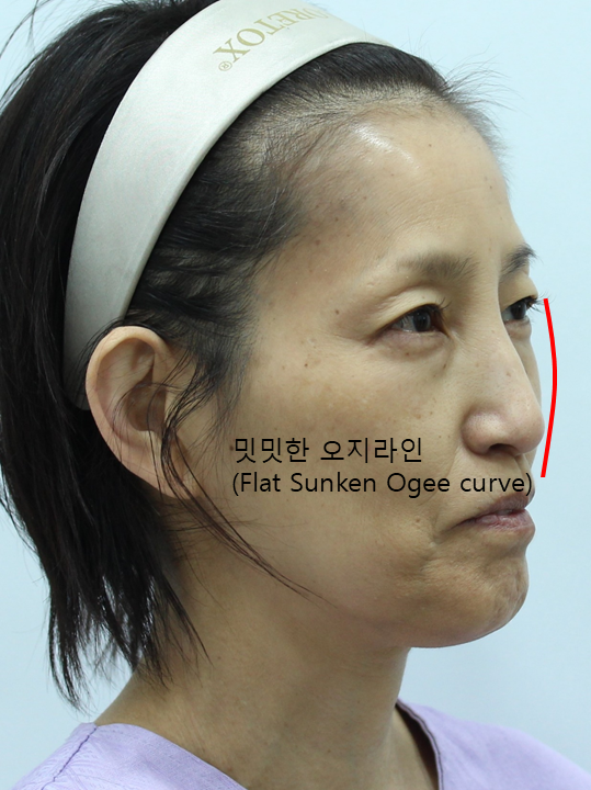 중안면의 볼륨감과 오지라인(Ogee curve) 관련 이미지 3
