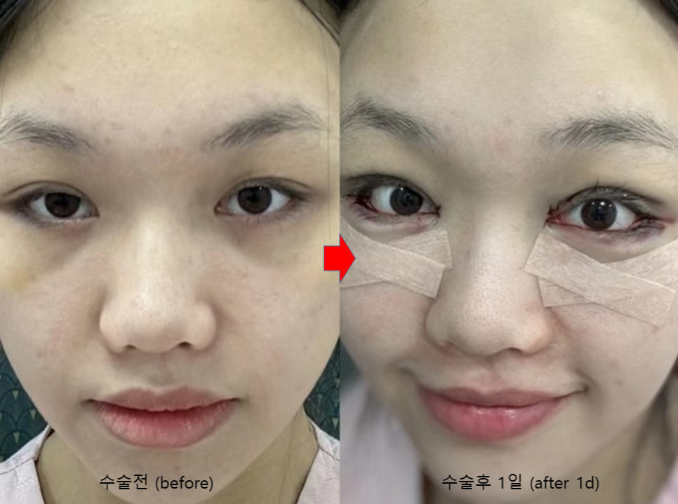 눈성형 종류 총정리, 어떤 수술부터 해야 할까요? 관련 이미지 4