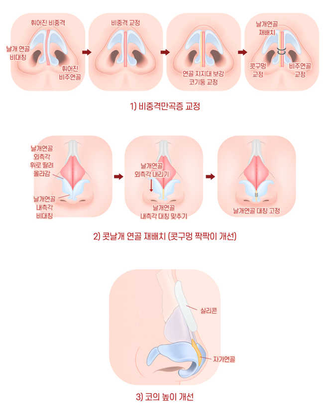 【Garnet Plastic Surgery Director Baek In-soo’s Plastic Surgery Column】 Facial Asymmetry and Crooked Nose Surgery image 5