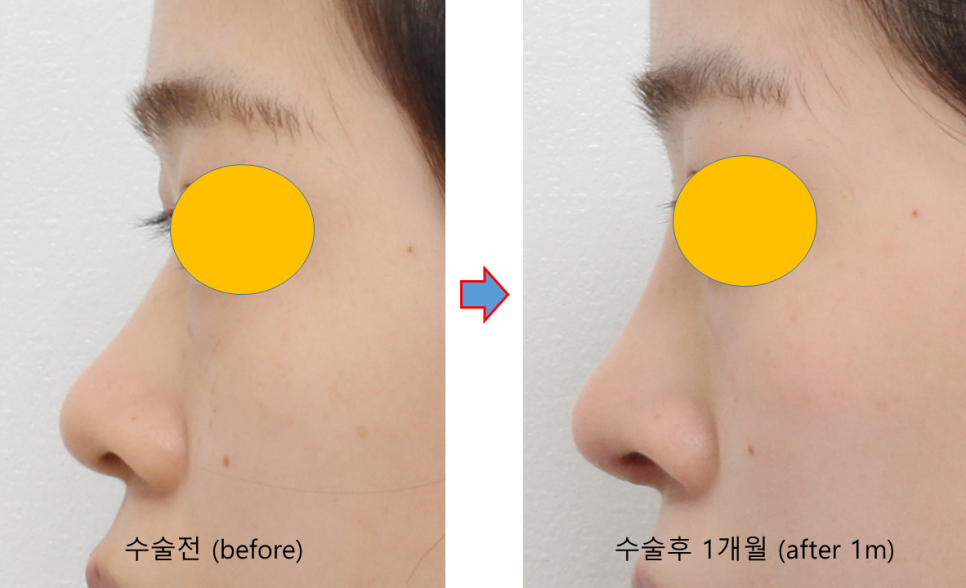 How to Naturally Enhance a Small Nose in Your First Nose Surgery image 4