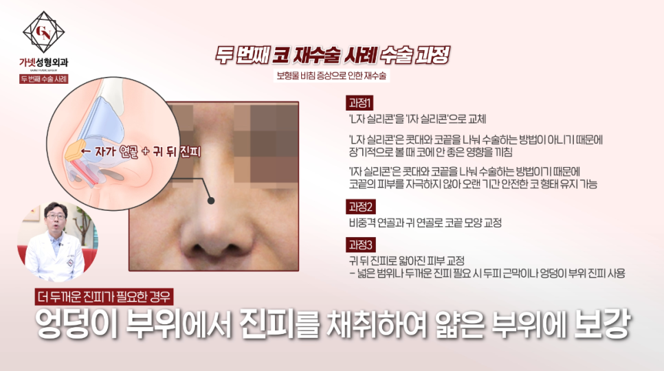 Why You Should Have Revision Rhinoplasty at a Place That Specializes in Apgujeong Nose Revision Surgery (ft. Dr. Baek In-soo) image 6