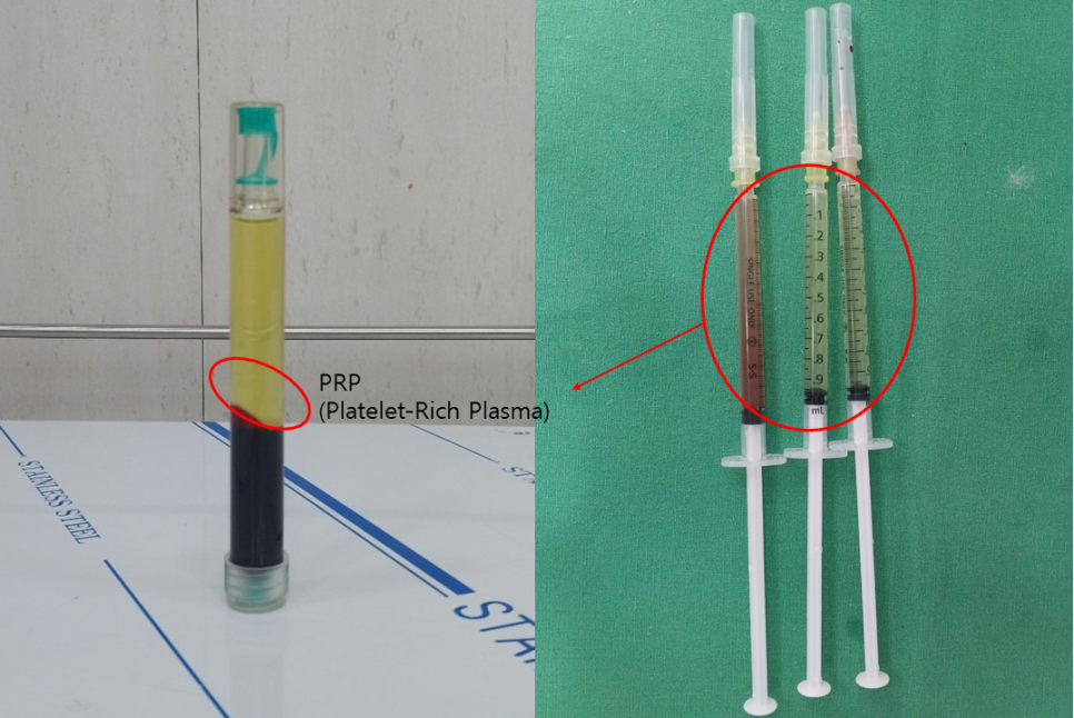PRP Fat Grafting to Correct a Peanut-Shaped Face image 6