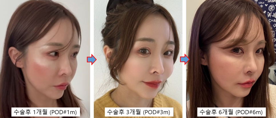 동안과 여성스러움을 동시에, 자연스러운 변화를 만드는 지방이식 관련 이미지 5