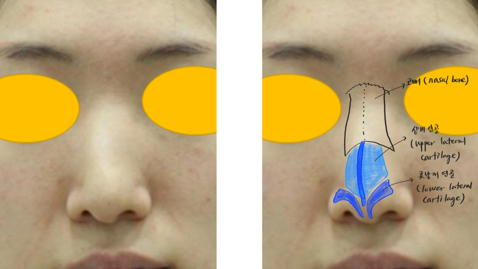 Various Surgical Methods for Crooked Nose Surgery image 1