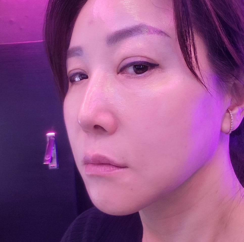 안면거상의 완성도를 높이는 펠리컨 수술 관련 이미지 6