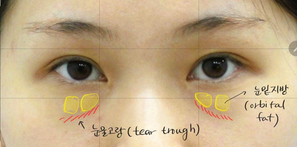 Under-Eye Fat Repositioning and Aegyo-Sal Fat Grafting image 3