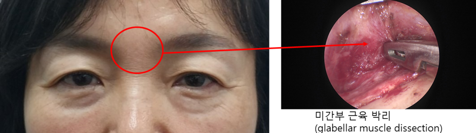 Why Horizontal Nasal Bridge Wrinkles and Eyelid Ptosis Occur Together, and the Role of Brow Lift Surgery image 2