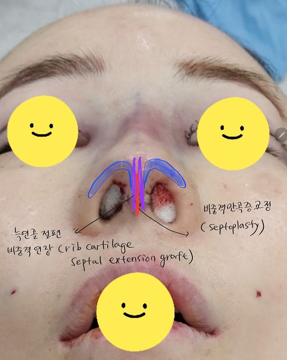 코끝떨어짐 늑연골 재수술 관련 이미지 4