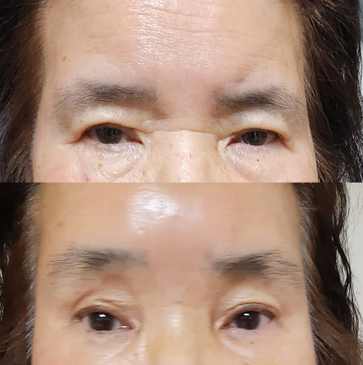 Surgical Methods That Reduce Nerve Symptoms in Endoscopic Brow Lift image 5