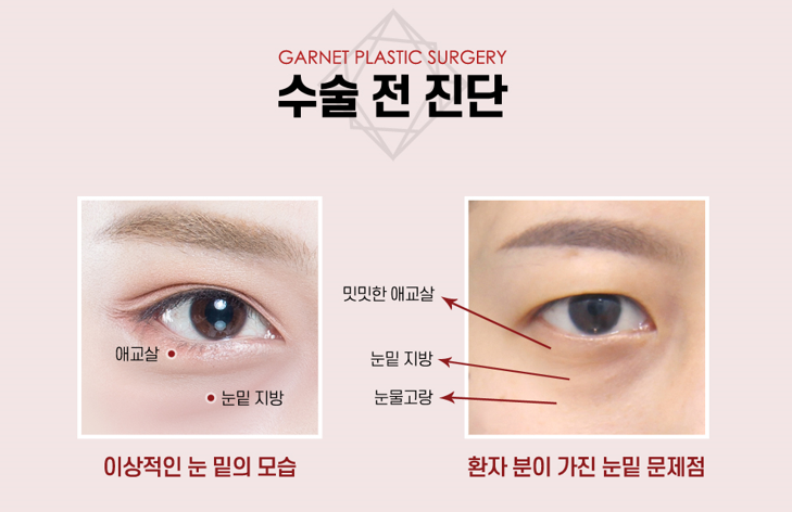 【Garnet Plastic Surgery Director Baek In-su’s Plastic Surgery Column】 Erasing Dark Circles with Under-Eye Fat Repositioning image 3
