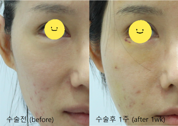 A Specialized Fat Grafting Correction Method for Hollowed Side Cheeks image 9