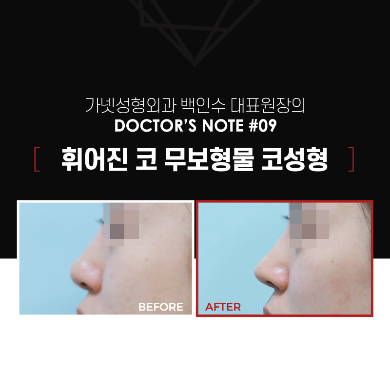 【가넷성형외과 백인수원장 성형칼럼】 휜코 무보형물 코성형 시 주의사항 관련 이미지 2