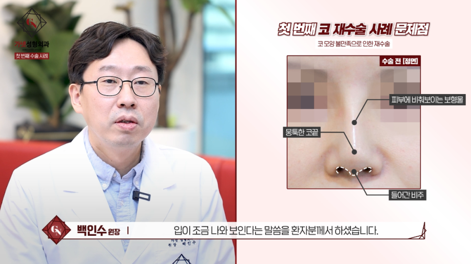 Why You Should Have Revision Rhinoplasty at a Place That Specializes in Apgujeong Nose Revision Surgery (ft. Dr. Baek In-soo) image 2