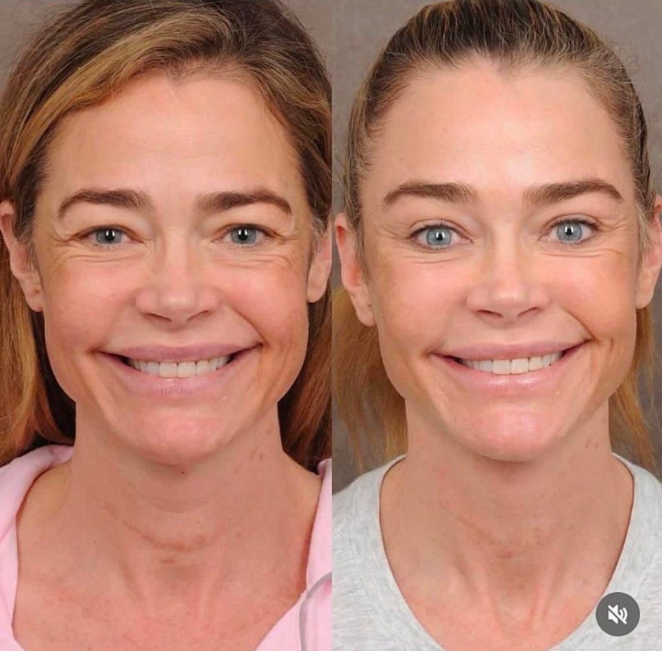 The Result of the $200,000 Anti-Aging Surgery Chosen by a Hollywood Star image 10