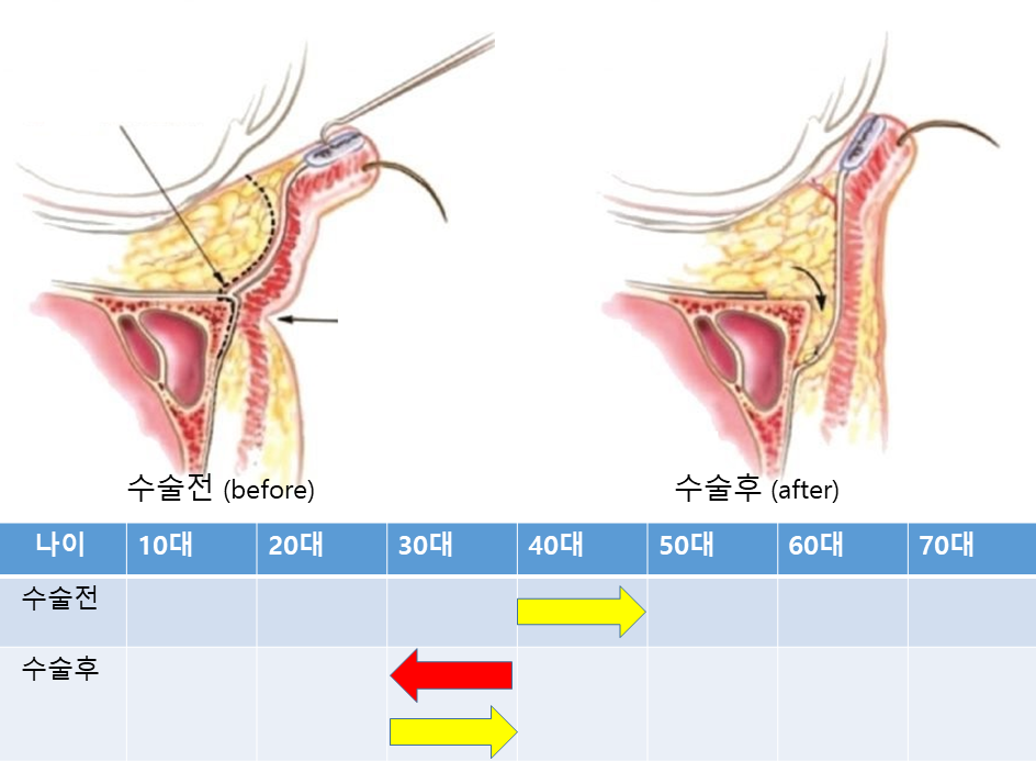 눈밑지방재배치와 애교살지방이식의 유지기간 관련 이미지 4