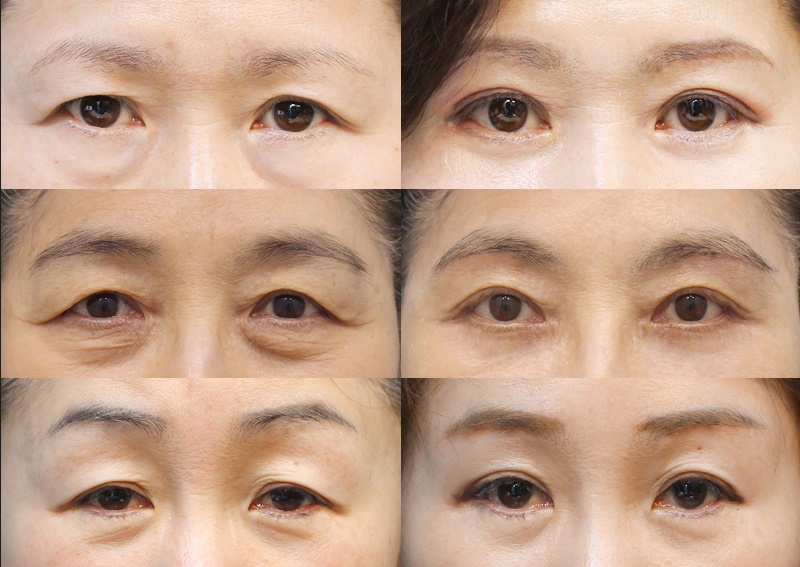Differences Between Upper Eyelid Lift and Upper Blepharoplasty, and Brow Lift Scars: Explained by a Board-Certified Plastic Surgeon image 18