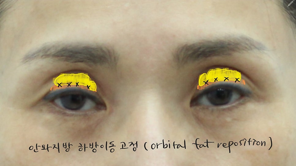 꺼진눈 쌍꺼풀 수술에서 필요한 눈위지방재배치 관련 이미지 4