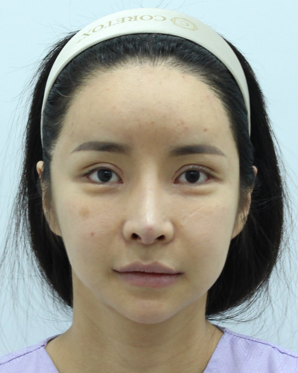 Sagging Skin After Facial Contouring Surgery (Cheek Sagging) image 2