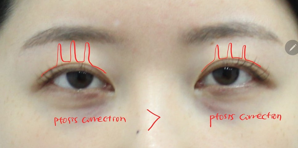 Non-incisional Eye Correction in Revision Surgery for Buried-Method Double Eyelids image 8