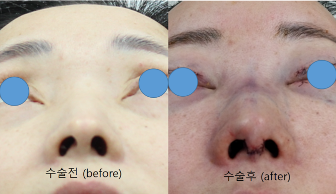 휜코와 동반된 매부리코의 교정 관련 이미지 9