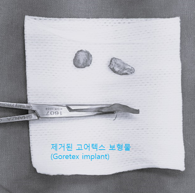 고어텍스 보형물을 자가조직으로 교체하는 코성형 관련 이미지 4