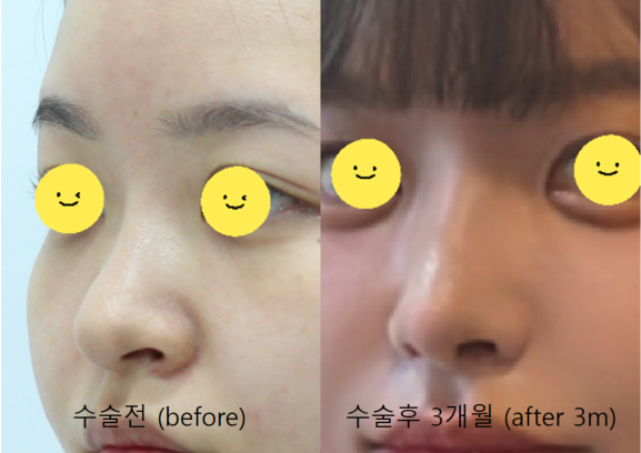 Nasal Tip Remodeling for Bulbous Nose and Drooping Columella Correction image 6