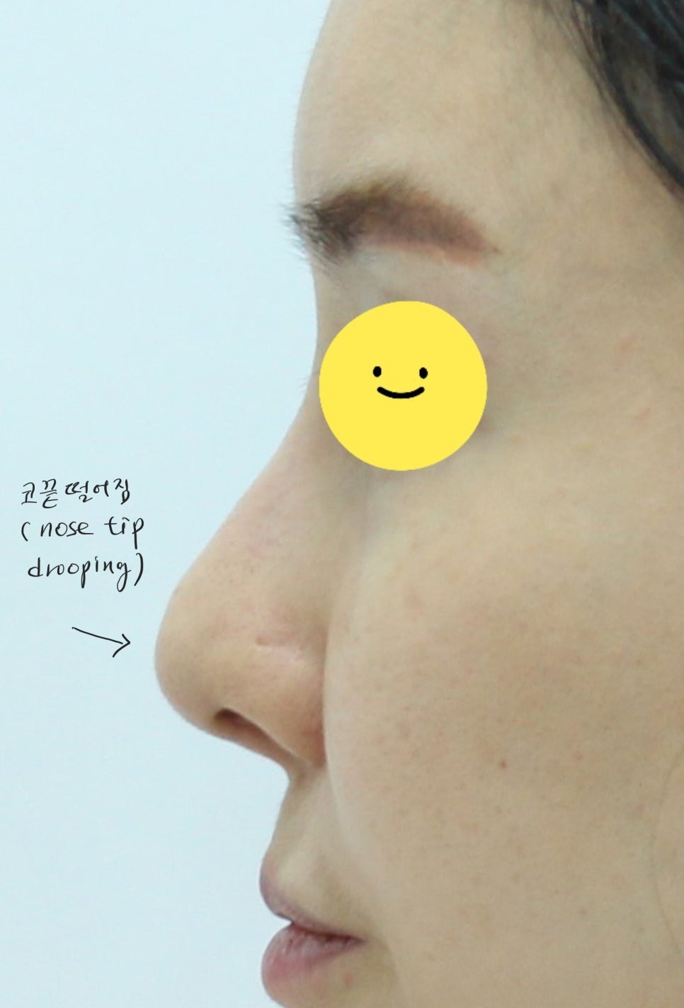 코끝떨어짐 늑연골 재수술 관련 이미지 1