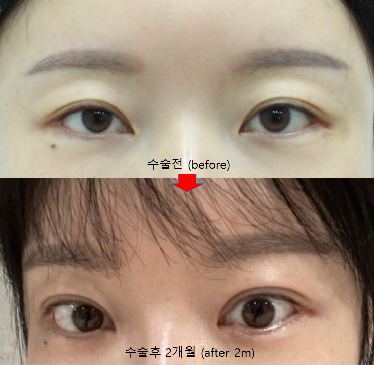 Non-incisional Eye Correction in Revision Surgery for Buried-Method Double Eyelids image 6